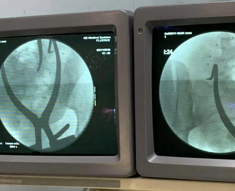 Paciente recuperada tras cirugía de columna lumbar